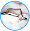 Limpieza y uso del irrigador bucal con aparatos de ortodoncia